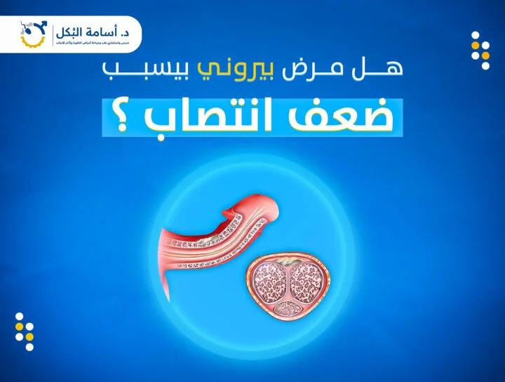 هل مرض بيروني يسبب ضعف الانتصاب؟