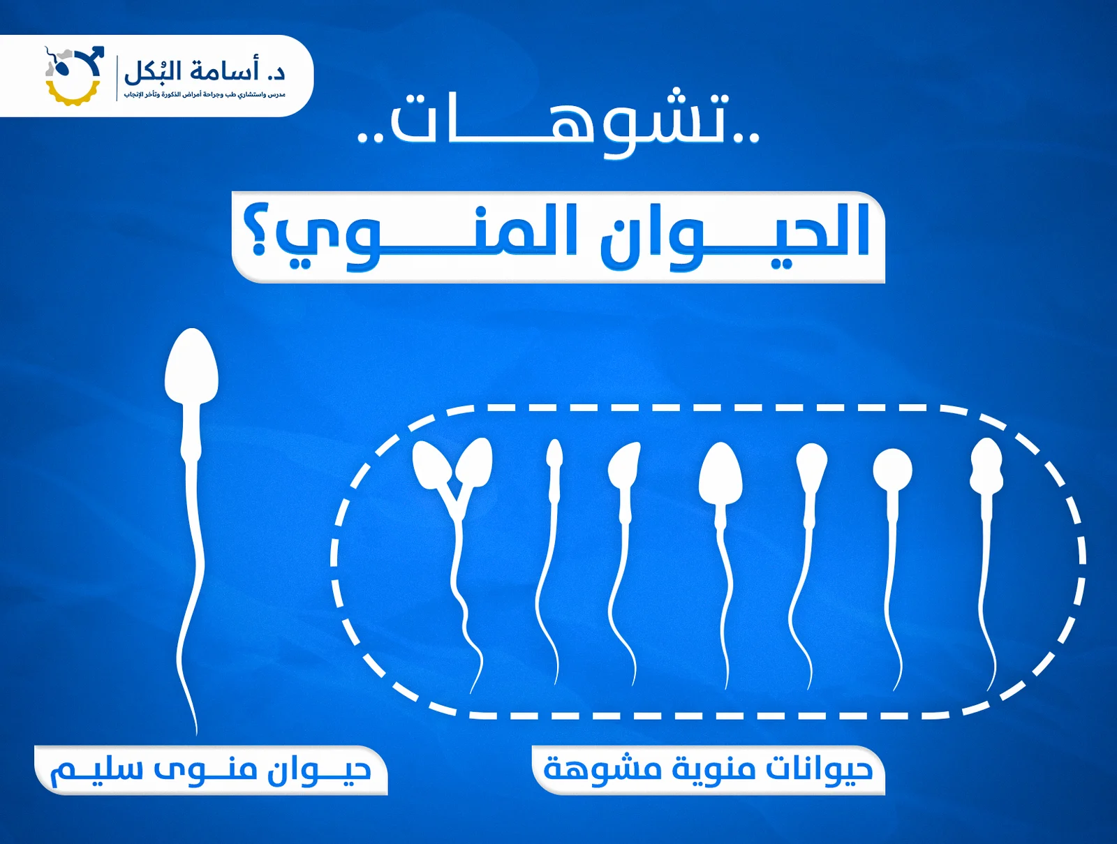 تكسير المادة الوراثية في الحيوانات المنوية والاجهاض المتكرر عند الزوجة